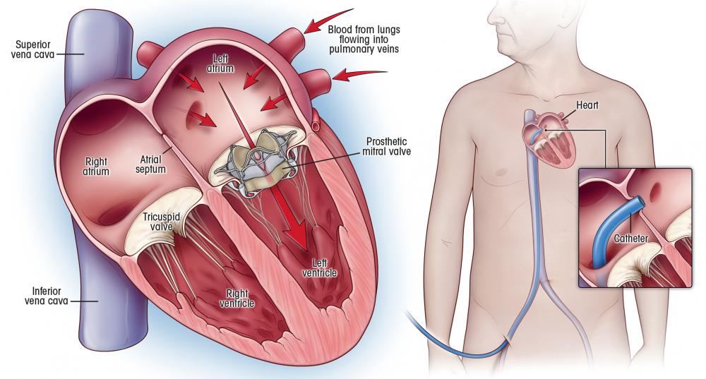 Mitral Valve Replacement That Can Be Done In Systematic Manner Health
