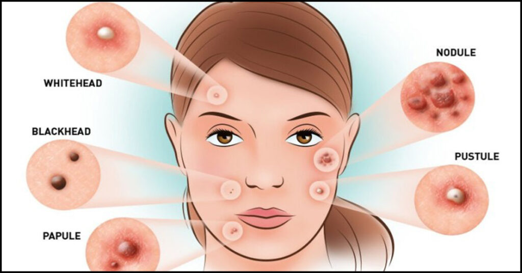 How to stop pimples coming on face naturally