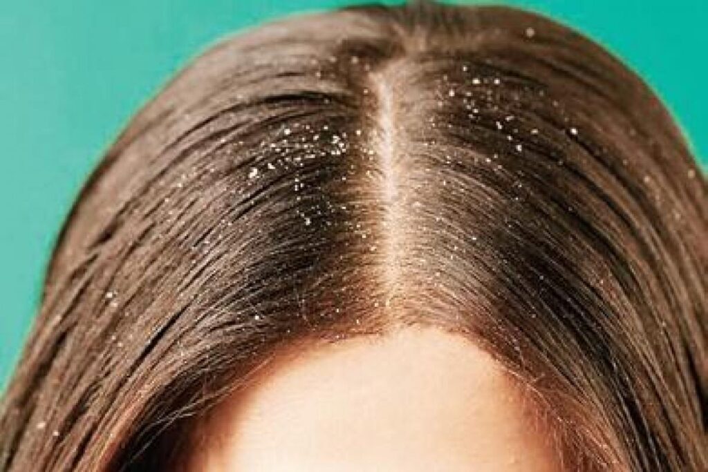 Dandruff vs Dry scalp: How Are They Different?