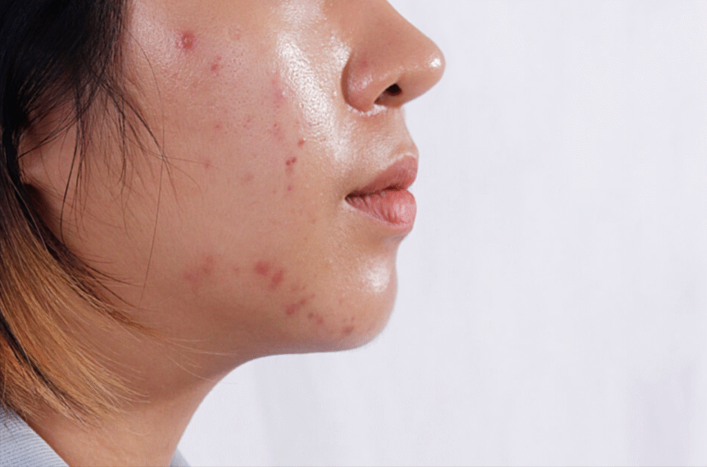 Oily & Acne Prone Skin Care
